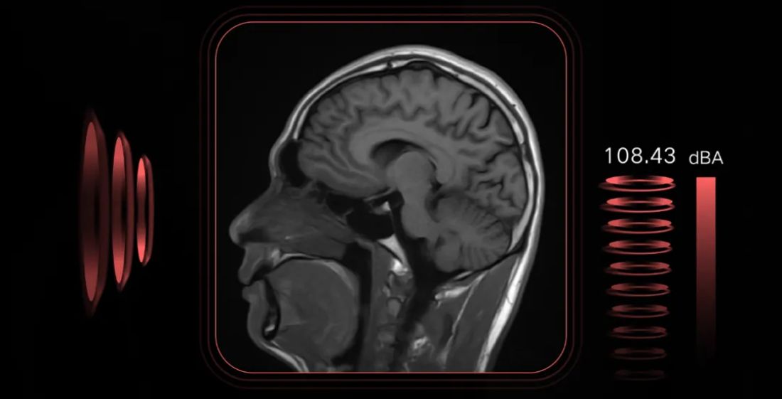 qué es la Resonancia Magnética sin Helio